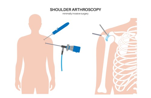 arthroscopy_shoulder_